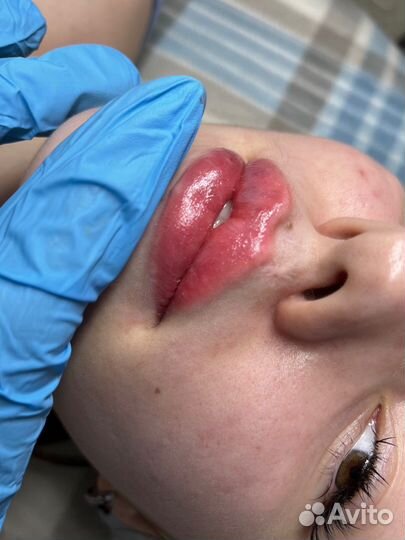 Увеличение губ,углы Джоли, биоревитализация,ботокс