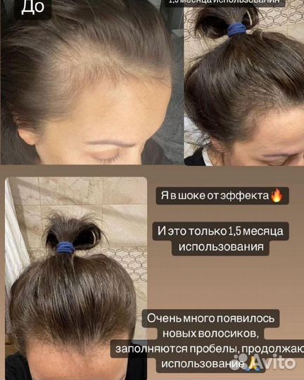 Спрей для роста волос Атоми