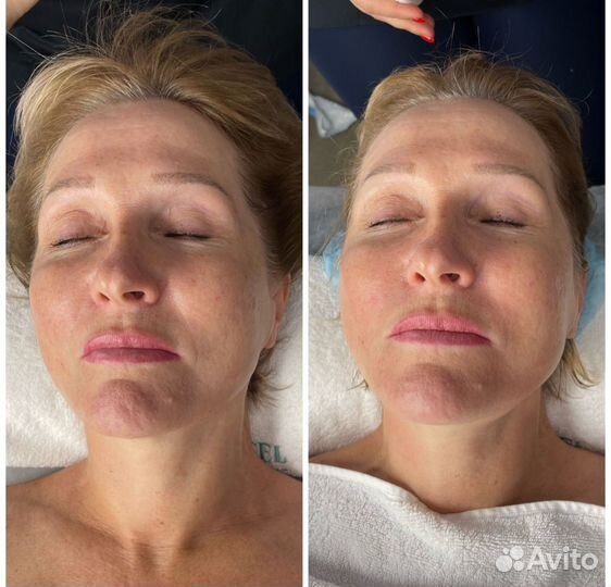 Массаж лица