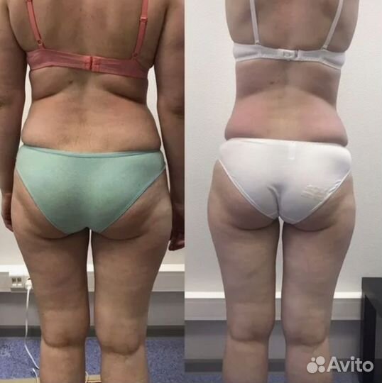 LPG идеальное тело- легко