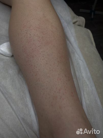 Электроэпиляция