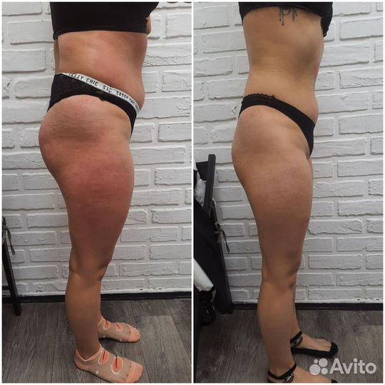 Аппаратный массаж