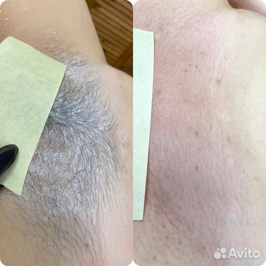 Депиляция воском шугаринг