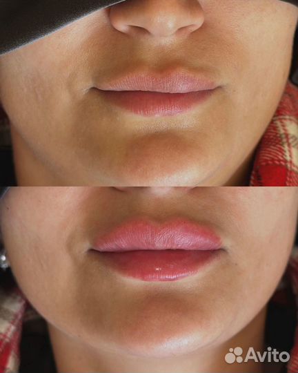 Увеличение губ
