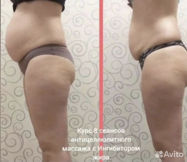 Антицеллюлитный массаж