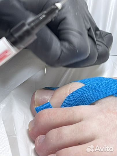 Медицинский препаратный педикюр, подолог