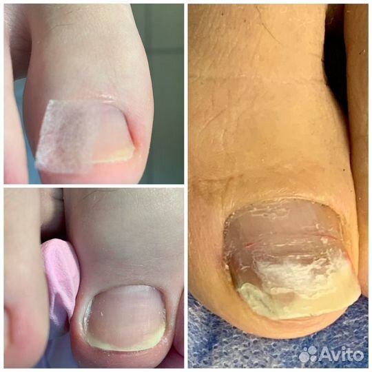 Педикюр медицинский, эстетический.Подология