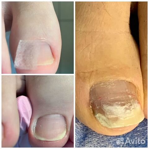 Педикюр медицинский, эстетический.Подология