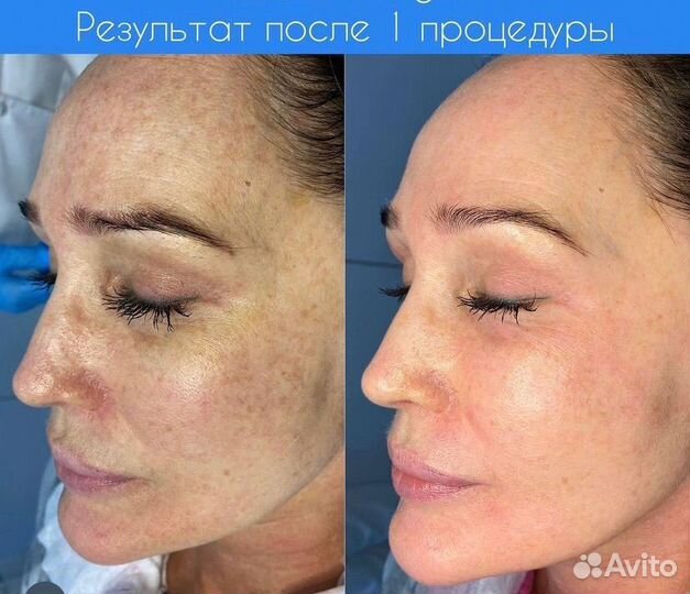 Morpheus 8 RF lifting #1 в мире