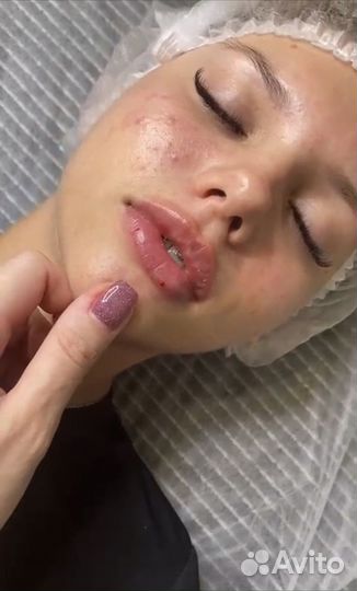Увеличение губ, филлеры