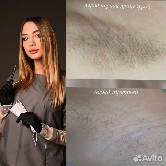 Электроэпиляция