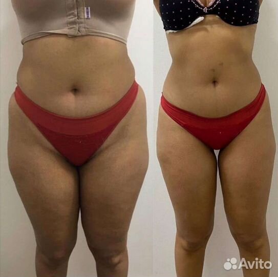 Антицеллюлитный массаж. Кавитация.RF-лифтинг