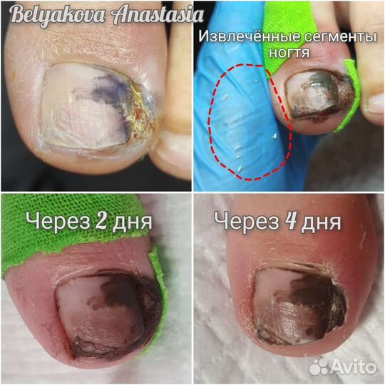 Подолог. Работа со сложными стопами