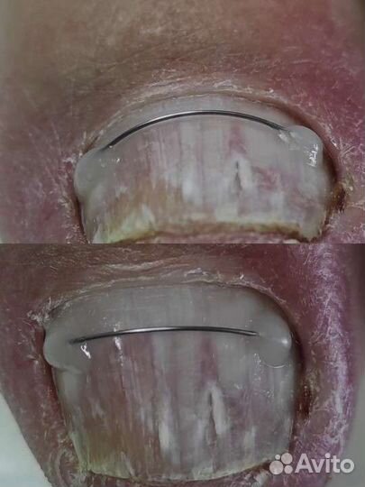 Услуги подолога / парамедицинский педикюр