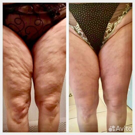 Антицеллюлитный шок аппаратный массаж