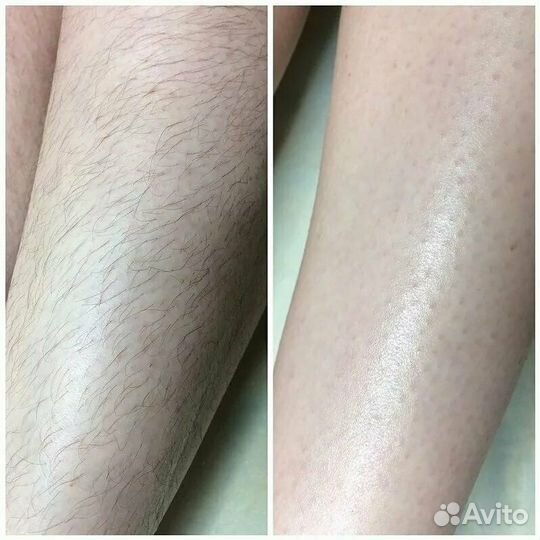 Шугаринг депиляция