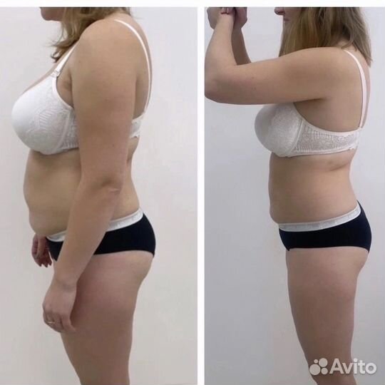 Коррекция фигуры, Вакуум, RF лифтинг, кавитация