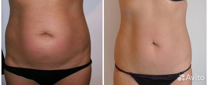 Модели на Липолазер Живота