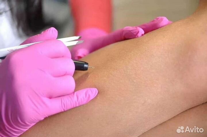 Электроэпиляция