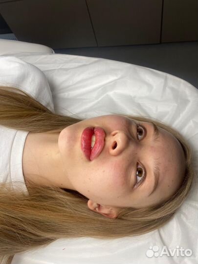 Увеличение губ