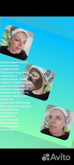 Лазерная эпиляция