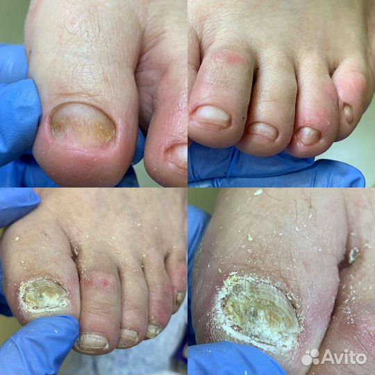 Педикюр,подологические услуги с выездом на дом