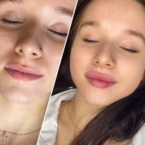 Услуги косметолога./Увеличение губ / Все техники, Подольск