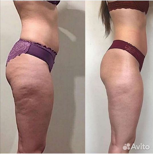 Антицеллюлитный массаж. Кавитация.RF-лифтинг