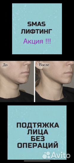 Smas-лифтинг