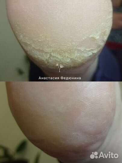 Подолог, Педикюр, SMART, Медицинский педикюр