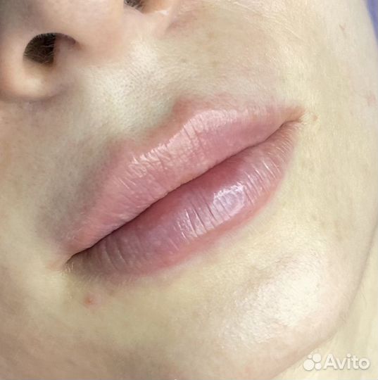 Увеличение губ