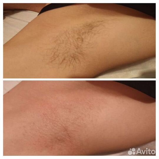 Шугаринг в солнечном