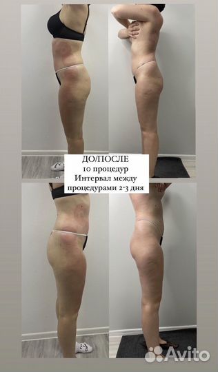 Антицеллюлитный/лимфодренажный массаж