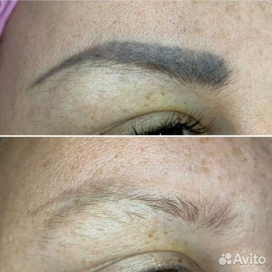 Удаление татуажа бровей модель