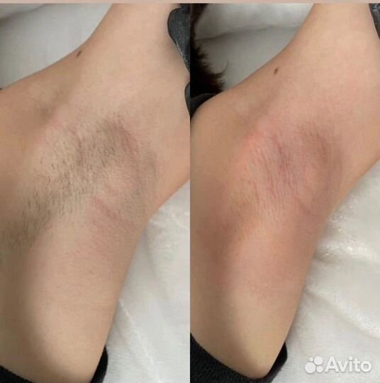 Шугаринг депиляция