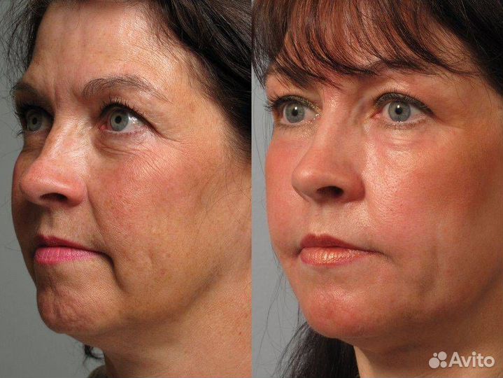 Модели на лазерную биоревитализацию лица бесплатно