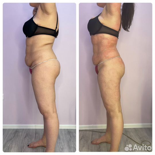 Массаж на двух аппаратах Старвак одновременно