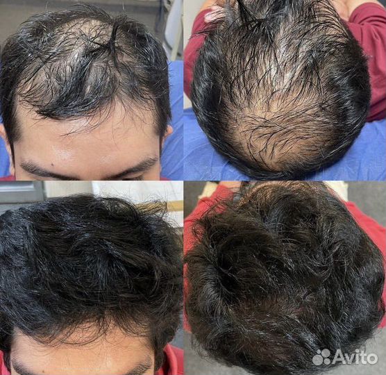 Лечение выпадения волос