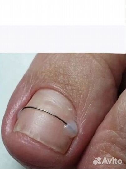 Титановый нити Light system коррекционная система