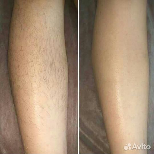 Шугаринг депиляция