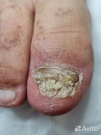 Педикюр вросший ноготь