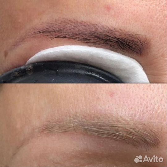 Удаление перманентного макияжа / татуажа