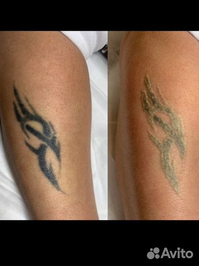 Лазерное удаление татуировки, татуаж, перманент