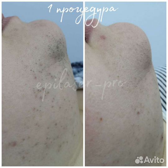 Лазерная эпиляция