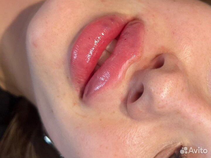 Увеличение губ модель