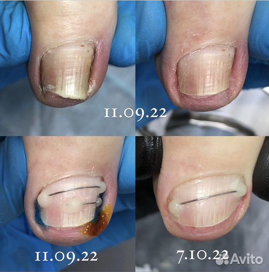 Педикюр Подолог Вросший ноготь Ростов