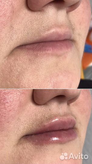 Контурная пластика