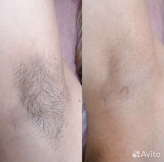 Шугаринг/ваксинг
