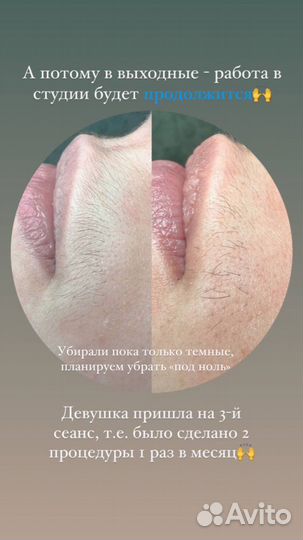 Электроэпиляция