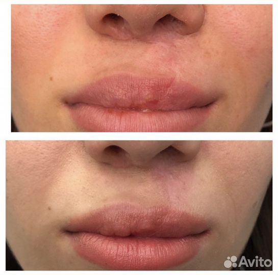 Коррекция шрамов, рубцов (авторская методика)